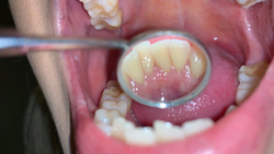 [個人]在黑色gal AV女星RISA的拋光牙齒中發現齲齒！ ？里薩③