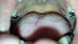 Persistent nasal cavity close-up Yuka II KITR00247