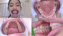 [치아 페티쉬】 사쿠라바 히카리 짱의 치아를 관찰했습니다!